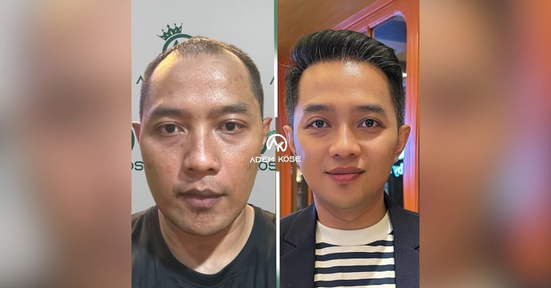 Biaya Tanam Rambut
