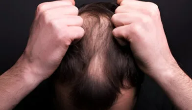 Jenis-Jenis Kebotakan dan Cara Mengatasinya Secara Medis